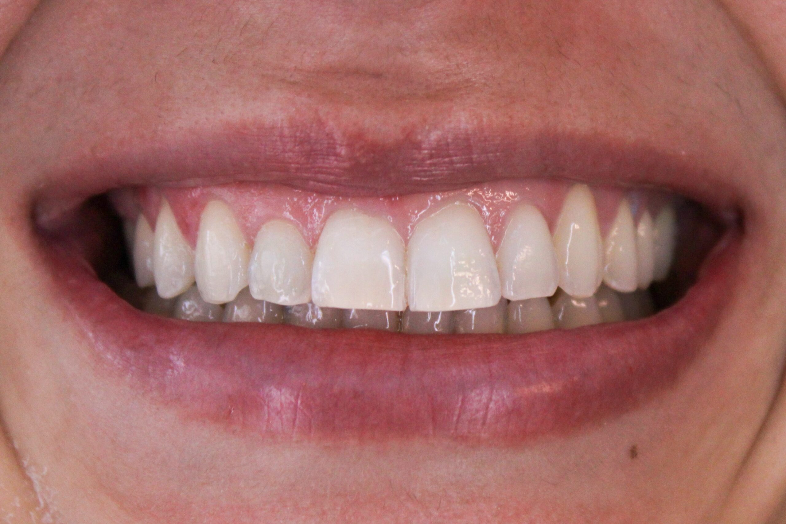 Sorriso depois do clareamento