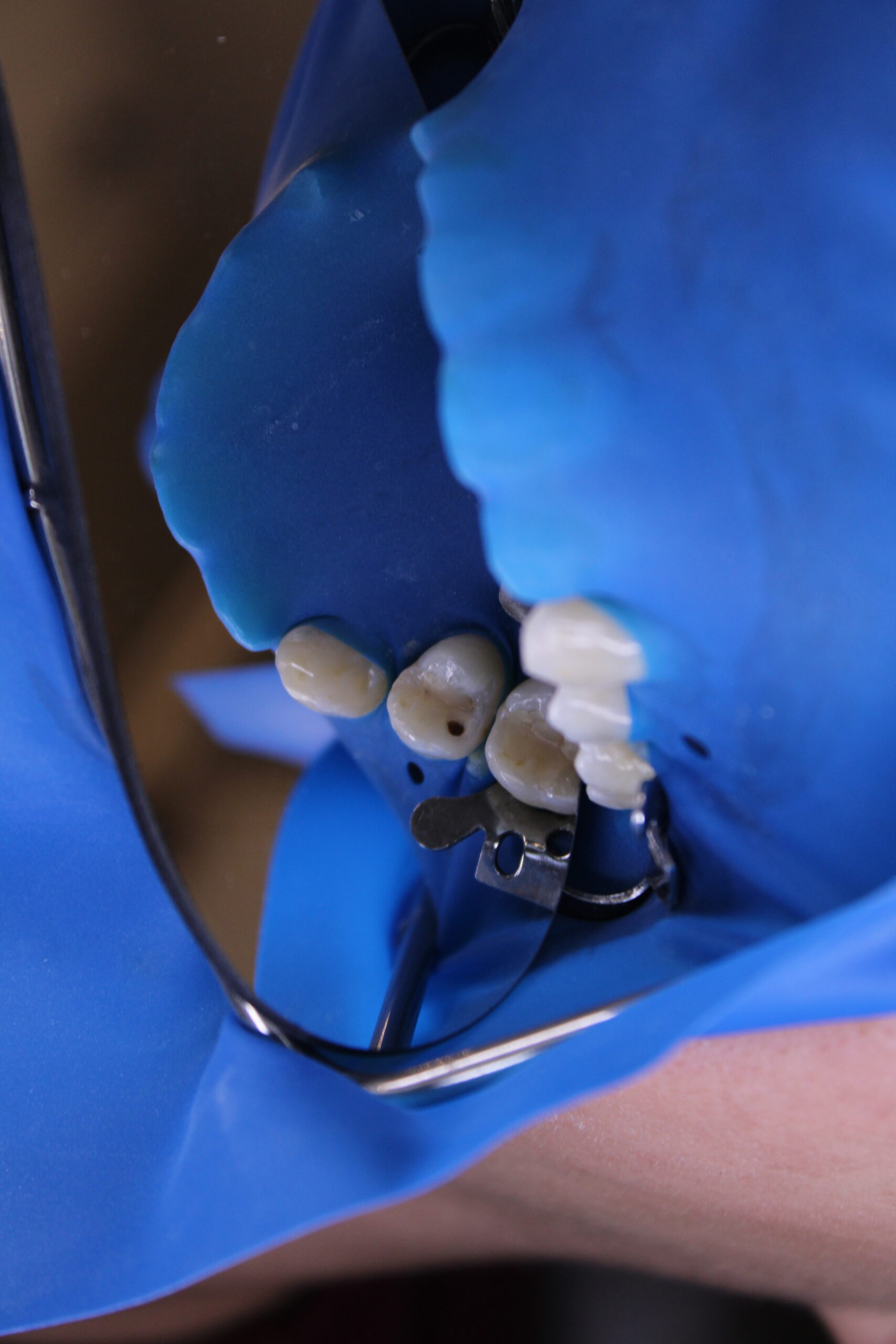 Dente antes da restauração