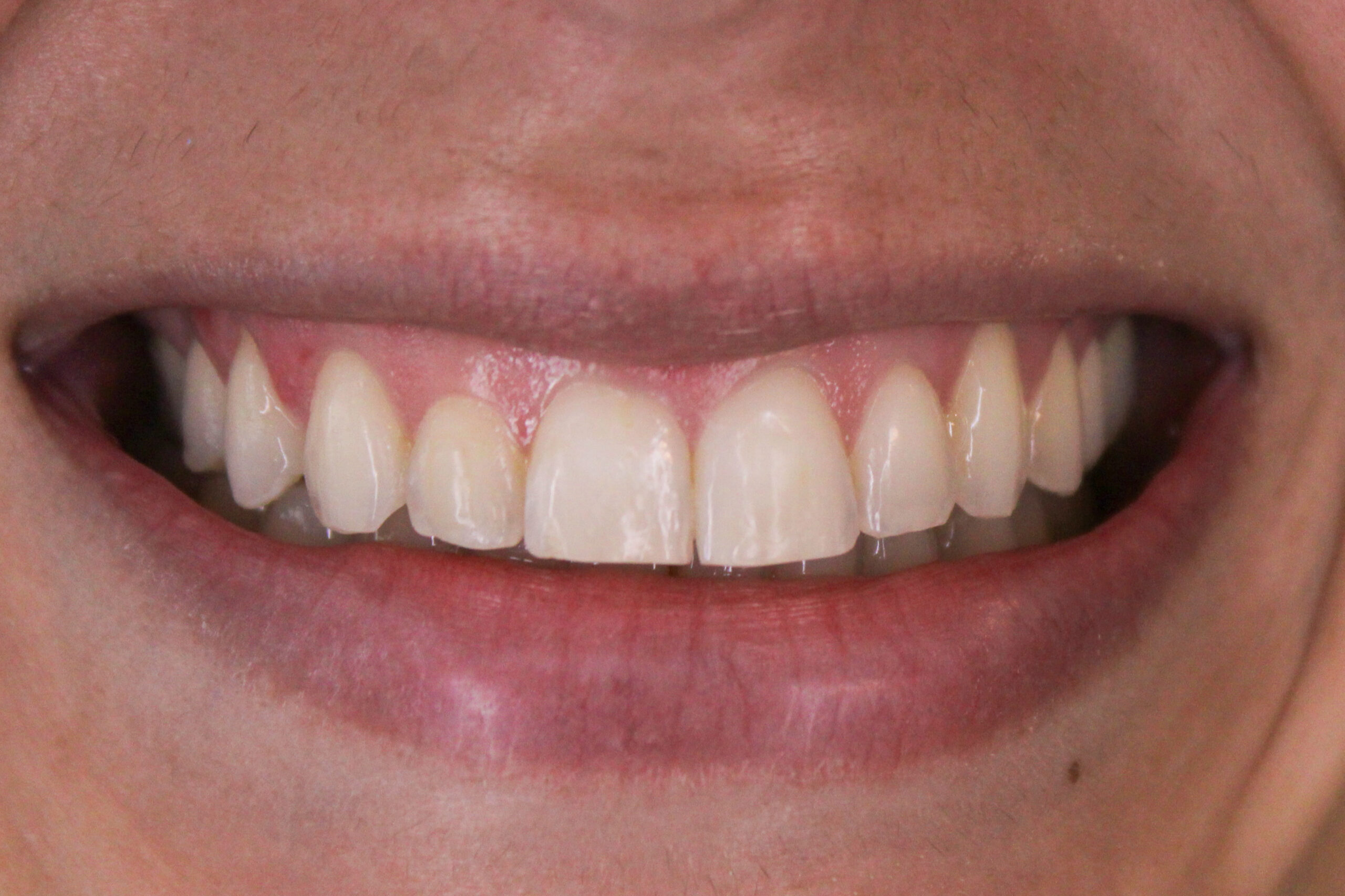 Sorriso antes do clareamento