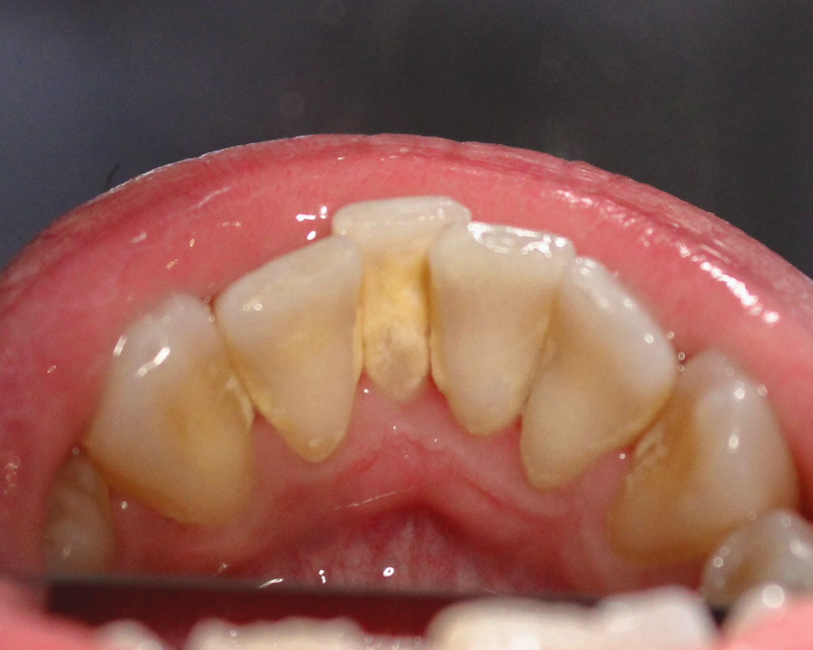 Dentes antes da raspagem