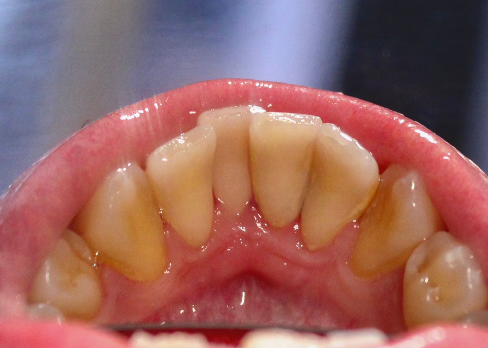 Dentes depois da raspagem